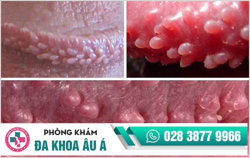 Gai sinh dục và cách hỗ trợ điều trị bệnh gai sinh dục hiệu quả