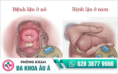 Những bệnh hoa liễu nguy hiểm và địa chỉ chuyên khám chữa