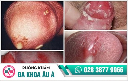 Bệnh lậu, căn bệnh nguy hiểm, lây lan nhanh và dễ kháng thuốc