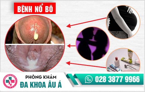 Bệnh nổ bô là gì? Phương pháp chữa bệnh nổ bô an toàn hiện nay Bệnh nổ bô là gì? Phương pháp chữa bệnh nổ bô an toàn hiện nay