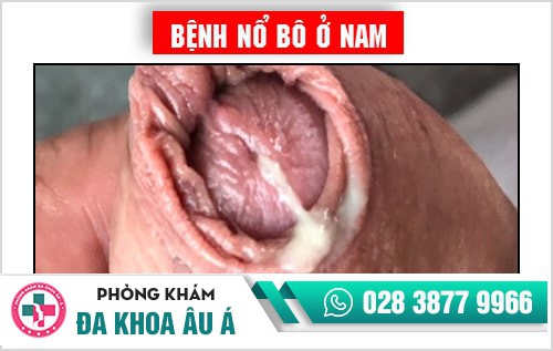 Bệnh nổ bô là gì? Phương pháp chữa bệnh nổ bô an toàn hiện nay Bệnh nổ bô là gì? Phương pháp chữa bệnh nổ bô an toàn hiện nay