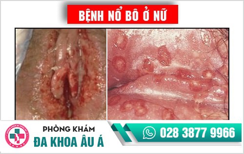 Bệnh nổ bô là gì? Phương pháp chữa bệnh nổ bô an toàn hiện nay Bệnh nổ bô là gì? Phương pháp chữa bệnh nổ bô an toàn hiện nay