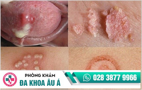Những bệnh hoa liễu nguy hiểm và địa chỉ chuyên khám chữa