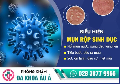 chữa mụn rộp sinh dục tại nhà
