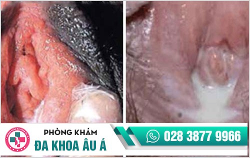 chữa bệnh lậu tại nhà
