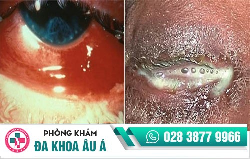 dấu hiệu bệnh lậu ở nam giới dấu hiệu bệnh lậu ở nam giới