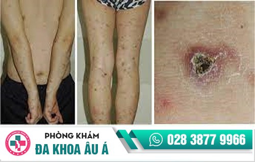 dấu hiệu bệnh lậu ở nam giới dấu hiệu bệnh lậu ở nam giới