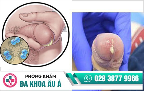 triệu chứng bệnh lậu ở nam giới triệu chứng bệnh lậu ở nam giới