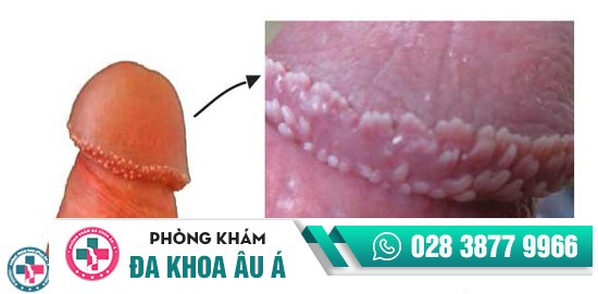 gai sinh dục