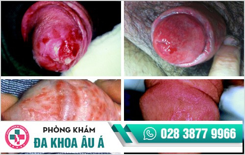 thuốc chữa trị hạt ngọc dương vật thuốc chữa trị hạt ngọc dương vật