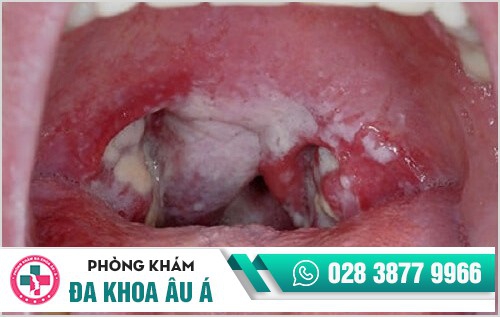 Hình ảnh bệnh lậu mãn tính