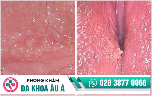 Gai âm đạo là gì? Phân biệt gai âm đạo và sùi mào gà Gai âm đạo là gì? Phân biệt gai âm đạo và sùi mào gà