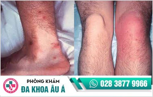 nguyên nhân bệnh lậu ở nam giới nguyên nhân bệnh lậu ở nam giới