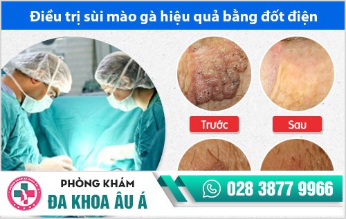 Bệnh viện chữa sùi mào gà có tốt hơn bệnh viện da liễu?