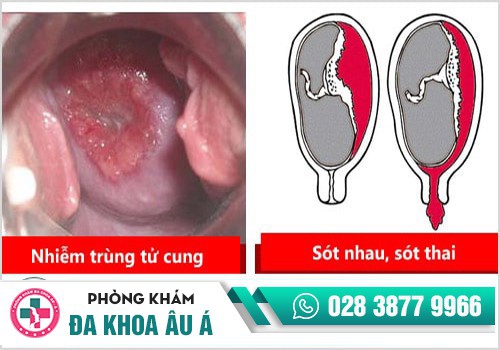 Tác hại của phá thai, hậu quả của phá thai không an toàn