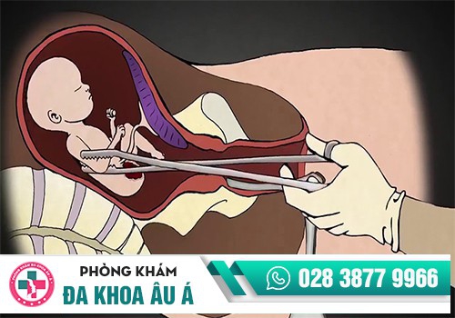 CÁC PHƯƠNG PHÁP ĐÌNH CHỈ THAI AN TOÀN